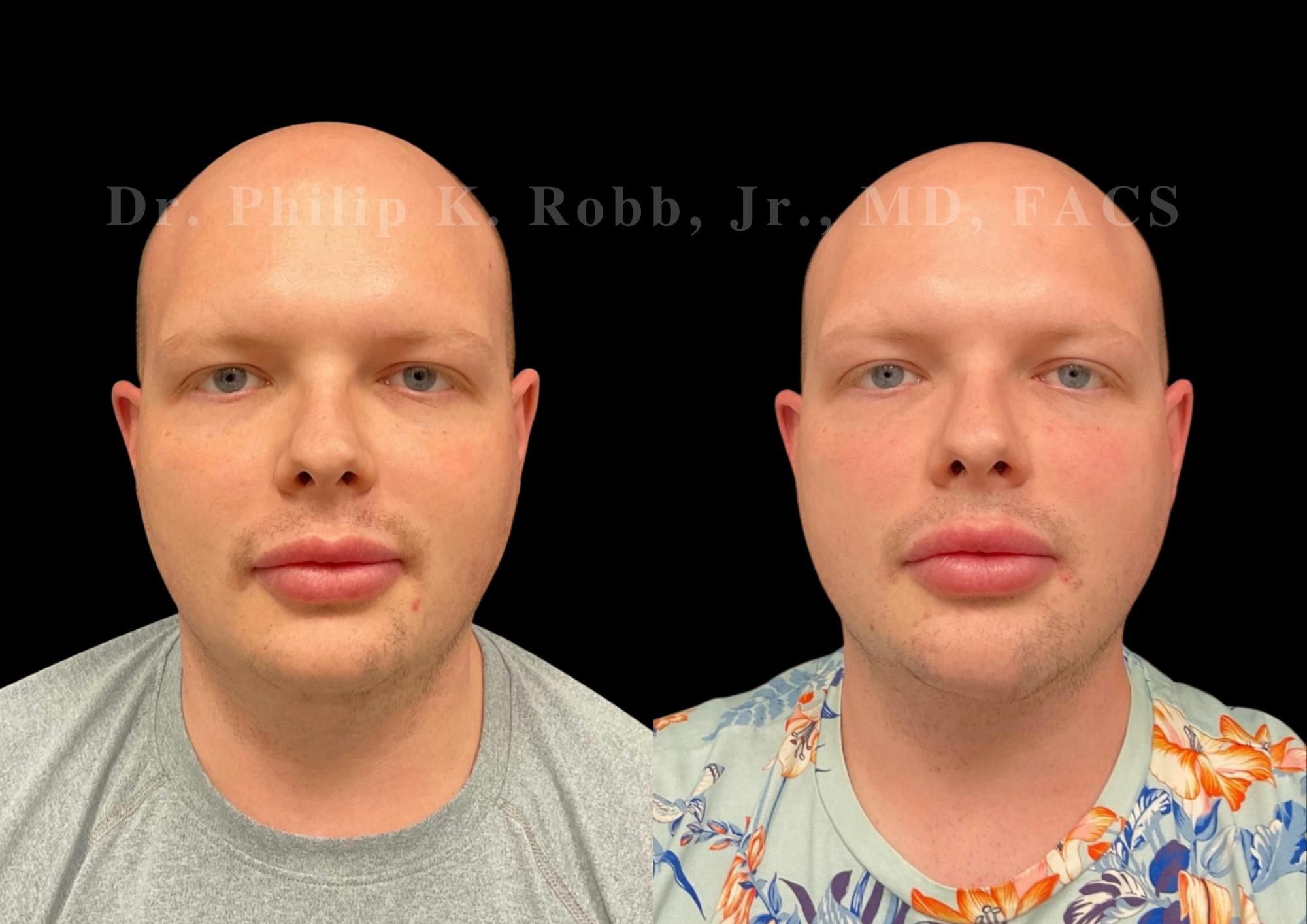 Neck Lift Before & After Gallery - Patient 262705 - Image 3