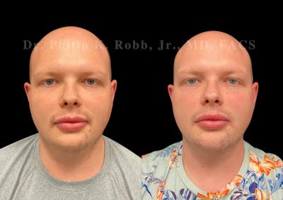 Buccal Fat Reduction Before & After Gallery - Patient 423889 - Image 1