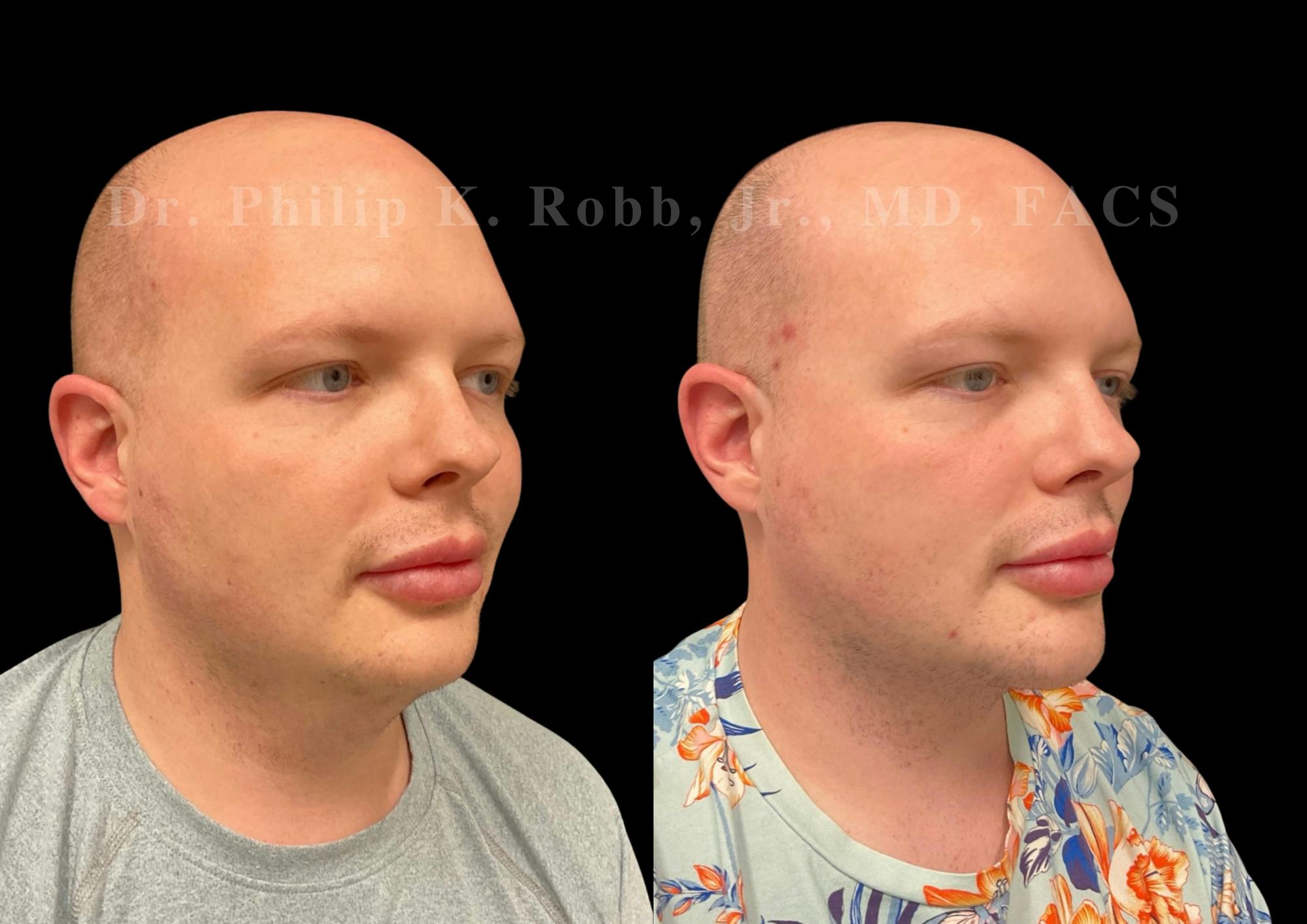 Fat Transfer Before & After Gallery - Patient 344606 - Image 2