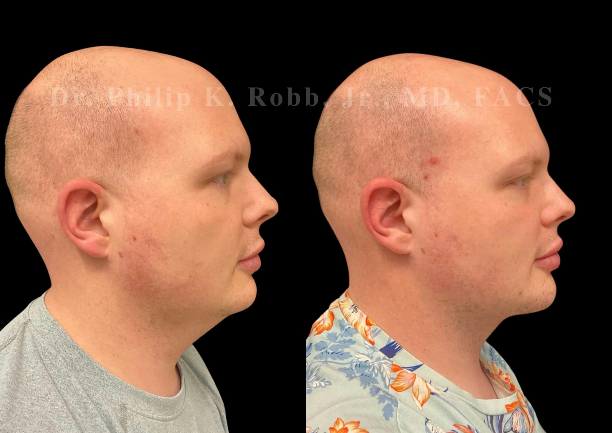 Chin Augmentation Before & After Gallery - Patient 262591 - Image 5