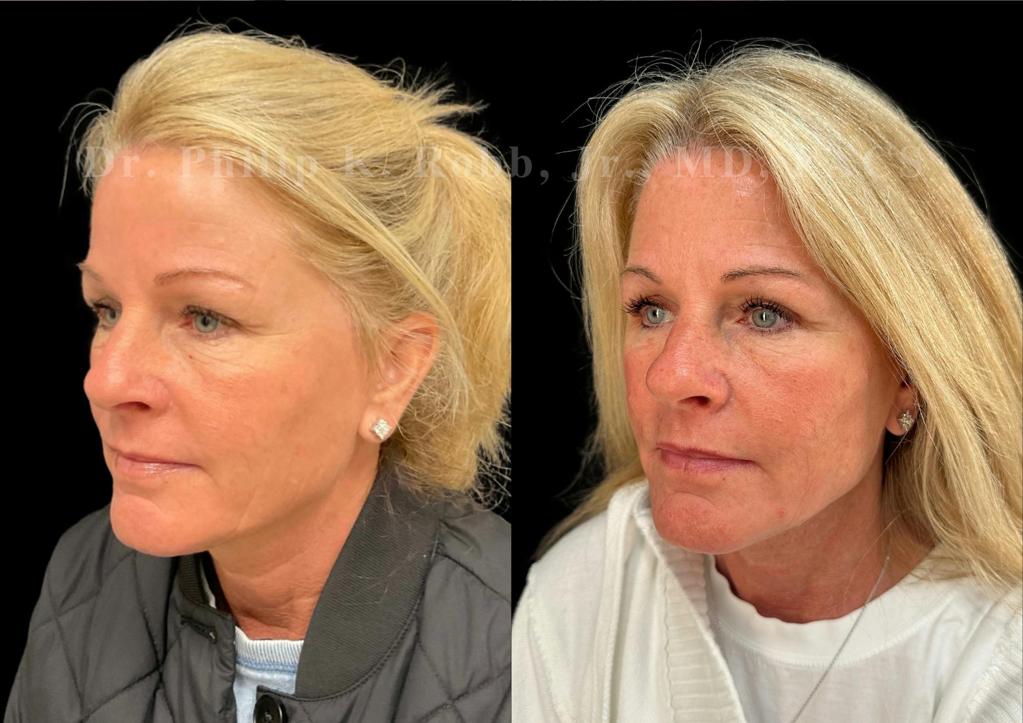 Upper Blepharoplasty Before & After Gallery - Patient 346961 - Image 3