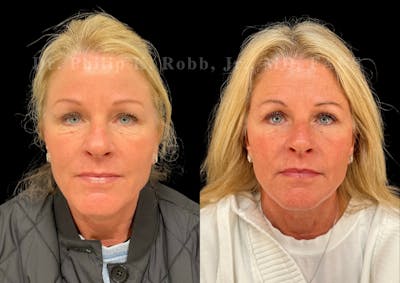 Upper Blepharoplasty Before & After Gallery - Patient 346961 - Image 1