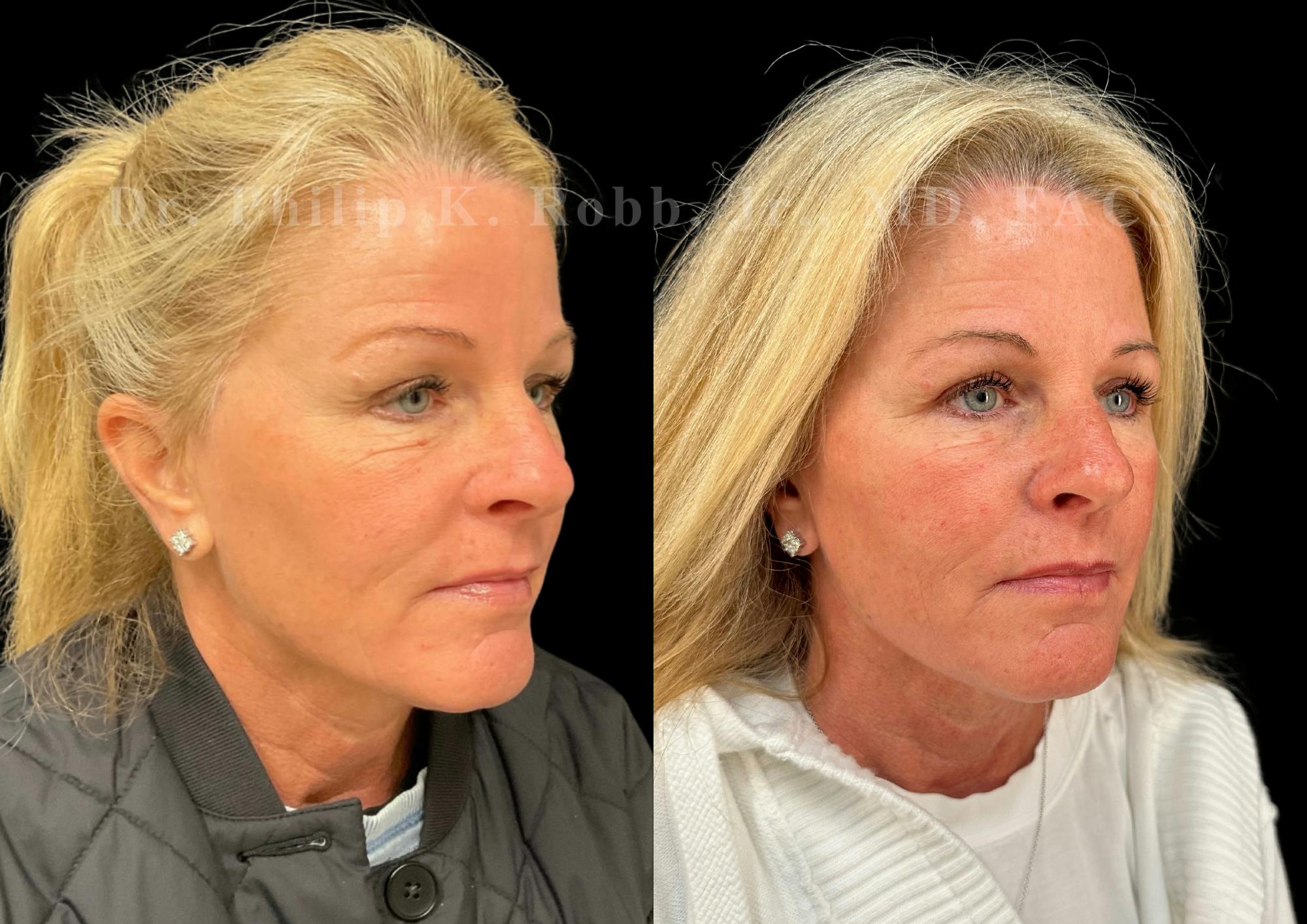 Upper Blepharoplasty Before & After Gallery - Patient 346961 - Image 2