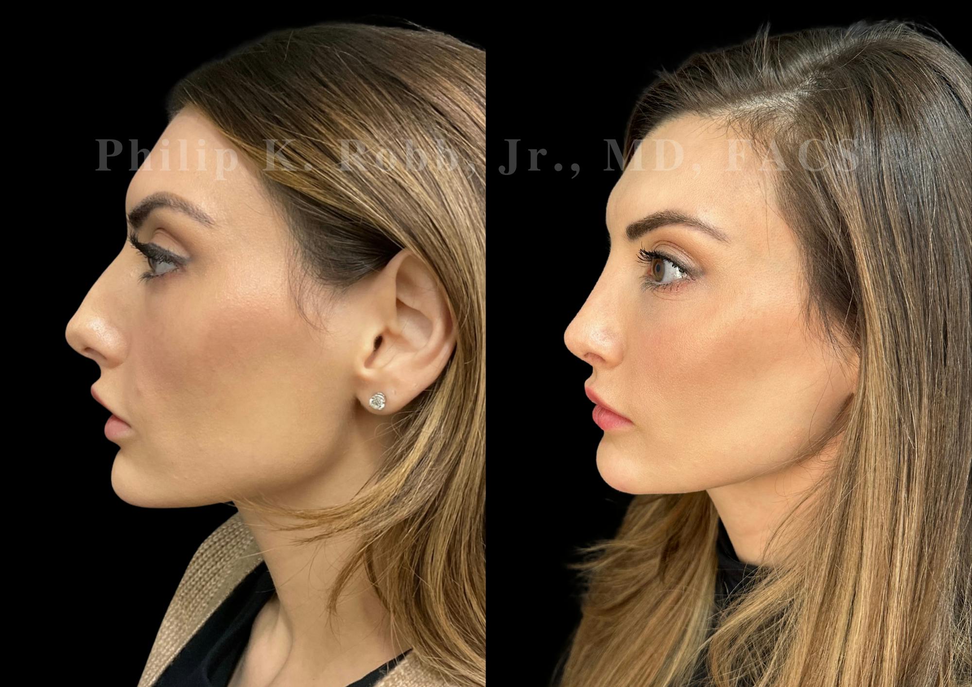 Ultrasonic Rhinoplasty Before & After Gallery - Patient 348492 - Image 5