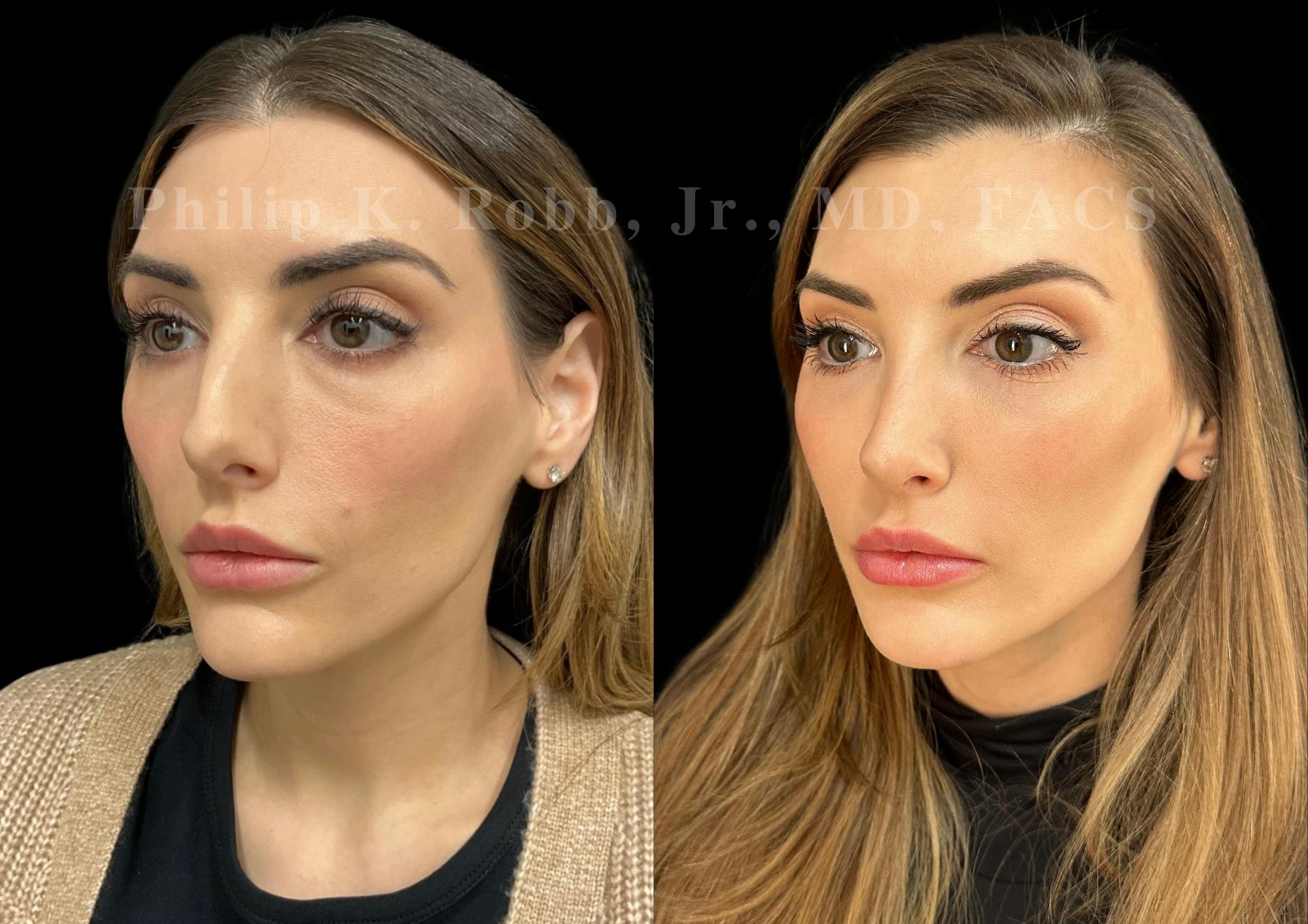Ultrasonic Rhinoplasty Before & After Gallery - Patient 348492 - Image 4