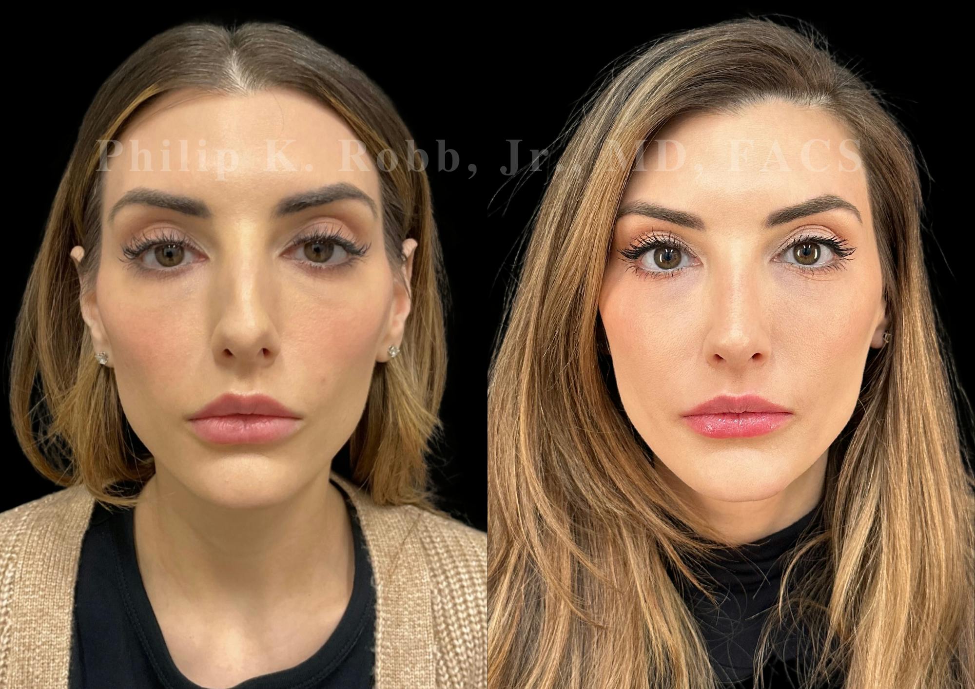 Ultrasonic Rhinoplasty Before & After Gallery - Patient 348492 - Image 3