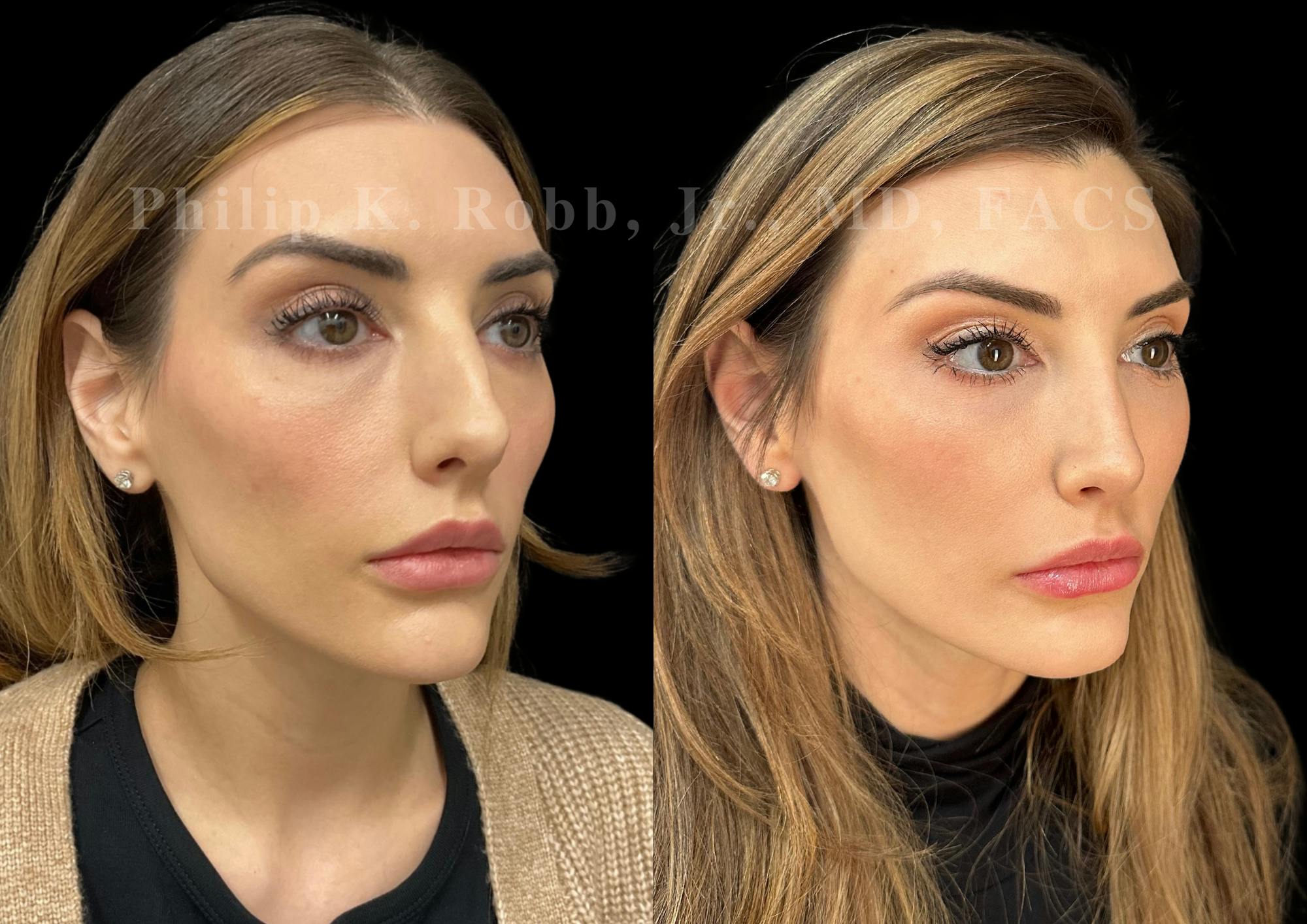 Ultrasonic Rhinoplasty Before & After Gallery - Patient 348492 - Image 2