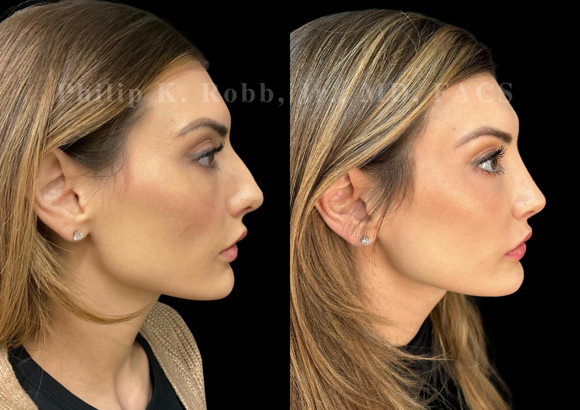 Ultrasonic Rhinoplasty Before & After Gallery - Patient 348492 - Image 1