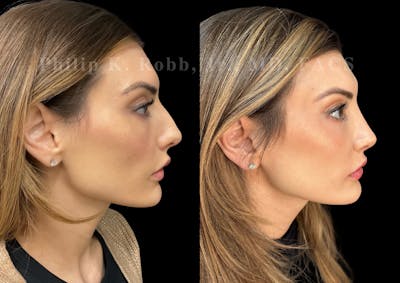 Ultrasonic Rhinoplasty Before & After Gallery - Patient 348492 - Image 1