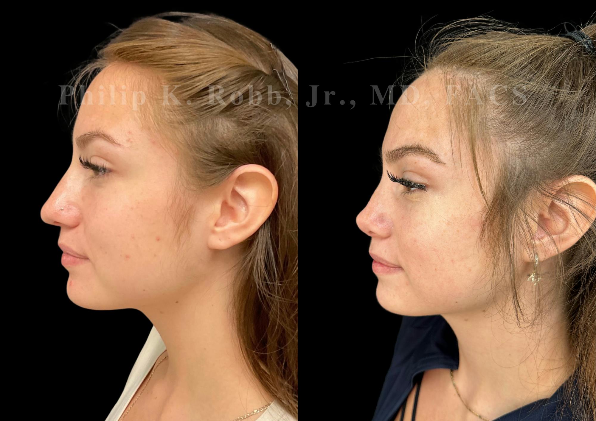 Ultrasonic Rhinoplasty Before & After Gallery - Patient 114408 - Image 5