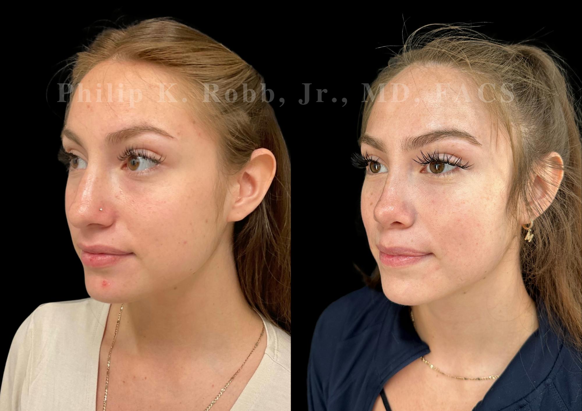 Ultrasonic Rhinoplasty Before & After Gallery - Patient 114408 - Image 4