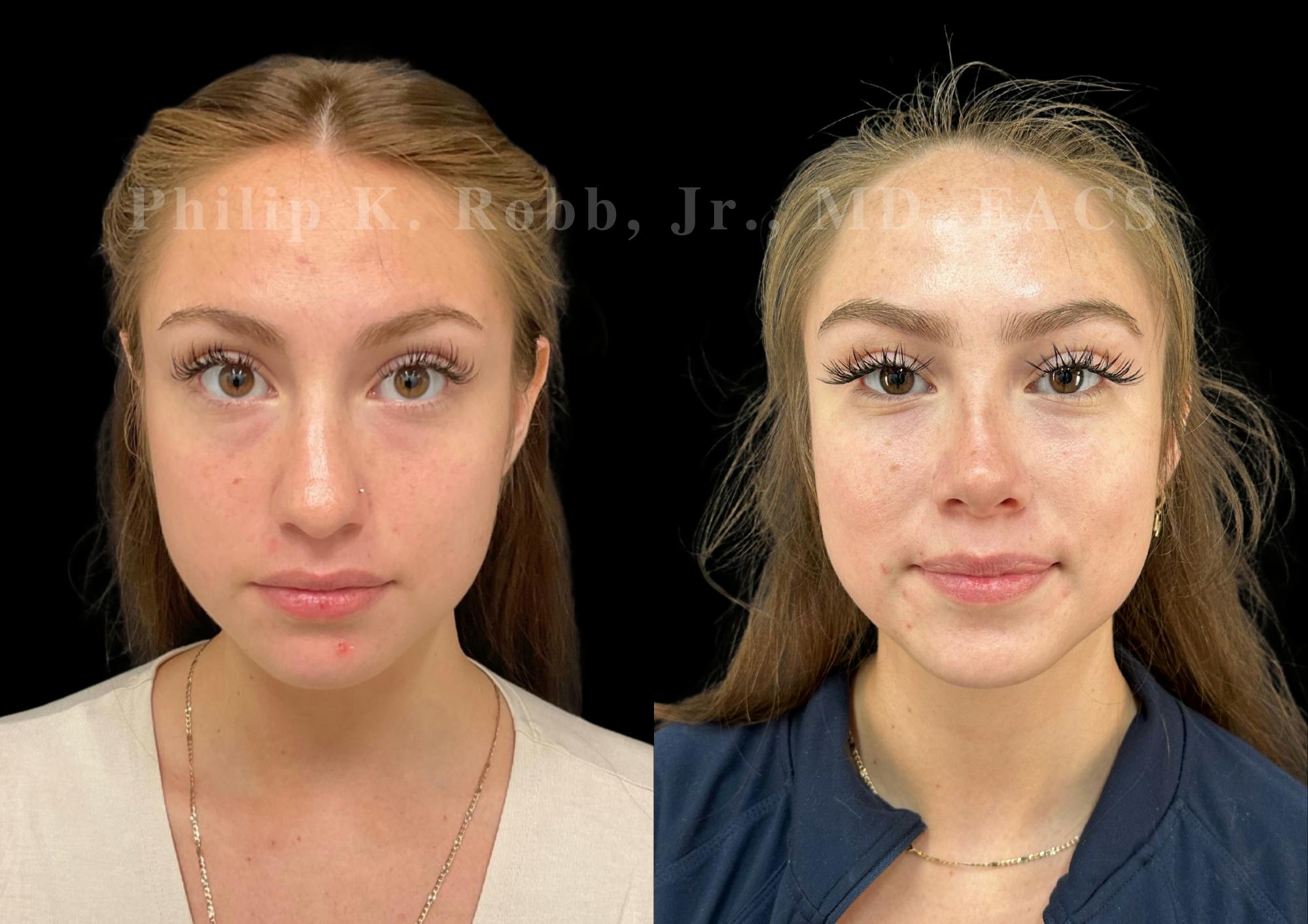 Ultrasonic Rhinoplasty Before & After Gallery - Patient 114408 - Image 3