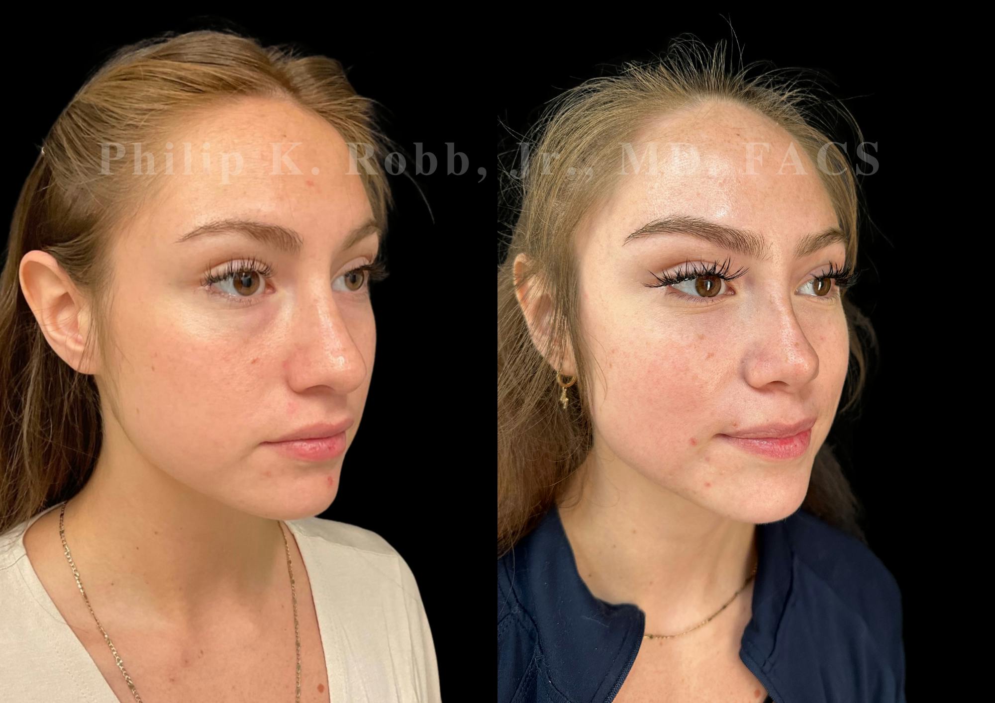 Ultrasonic Rhinoplasty Before & After Gallery - Patient 114408 - Image 2