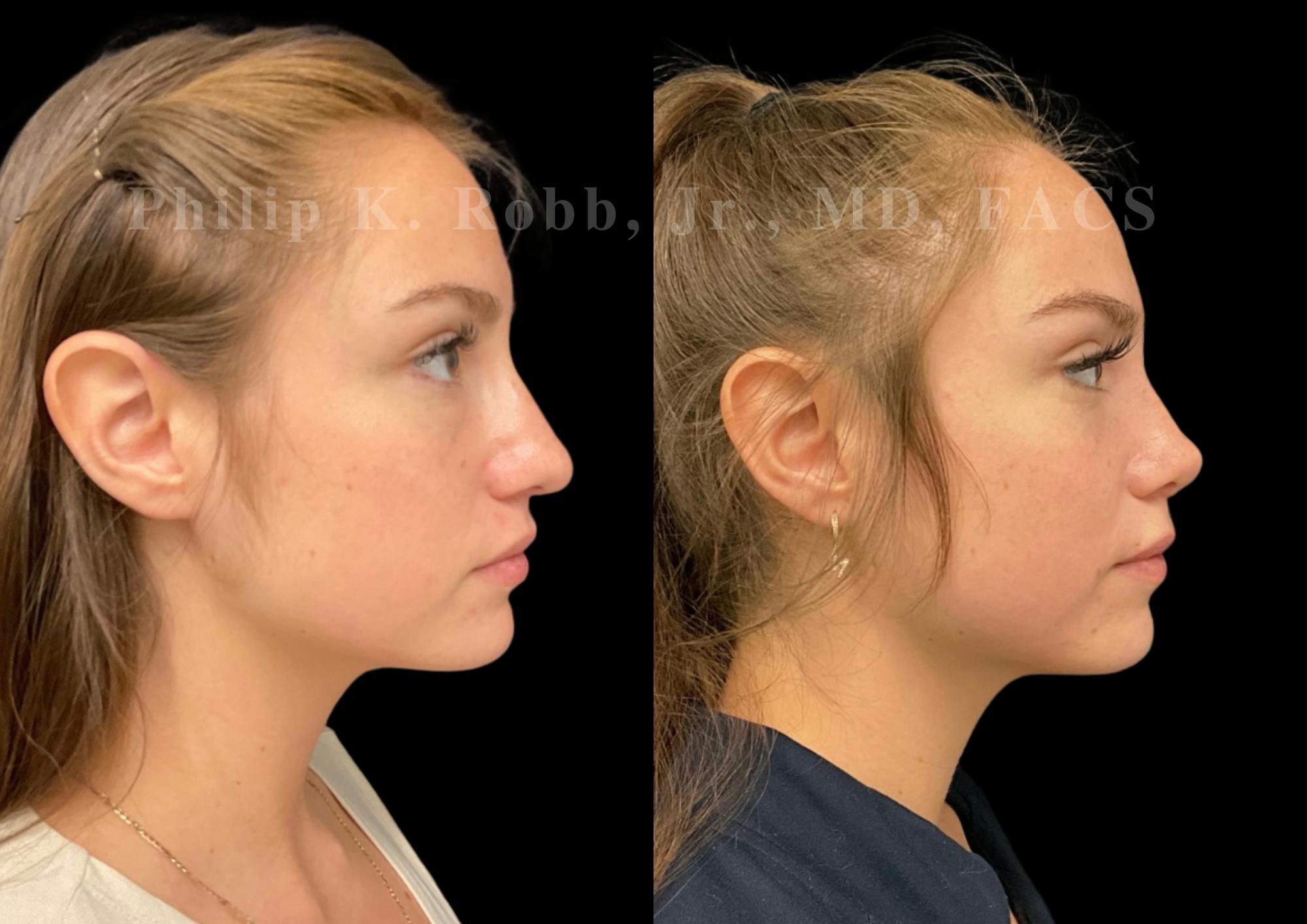 Ultrasonic Rhinoplasty Before & After Gallery - Patient 114408 - Image 1
