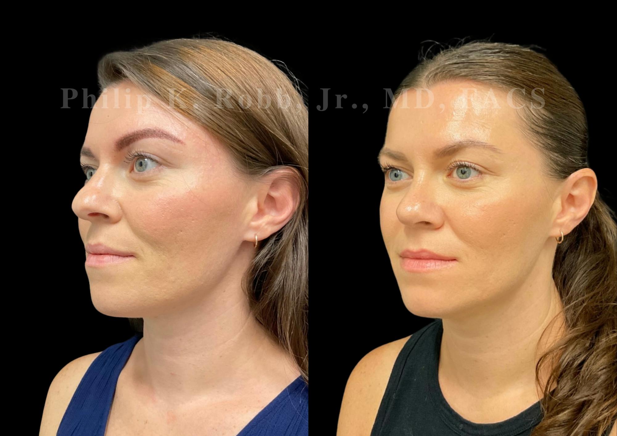 Ultrasonic Rhinoplasty Before & After Gallery - Patient 349449 - Image 4