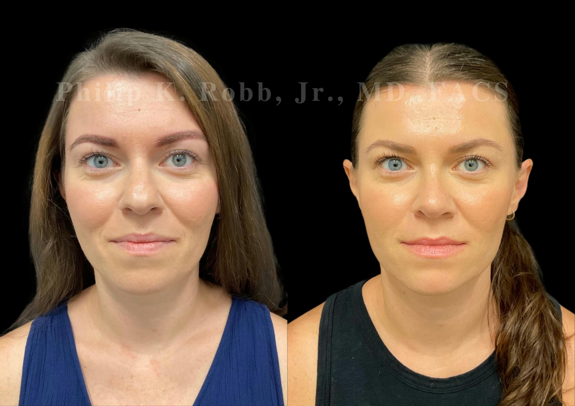 Ultrasonic Rhinoplasty Before & After Gallery - Patient 349449 - Image 3