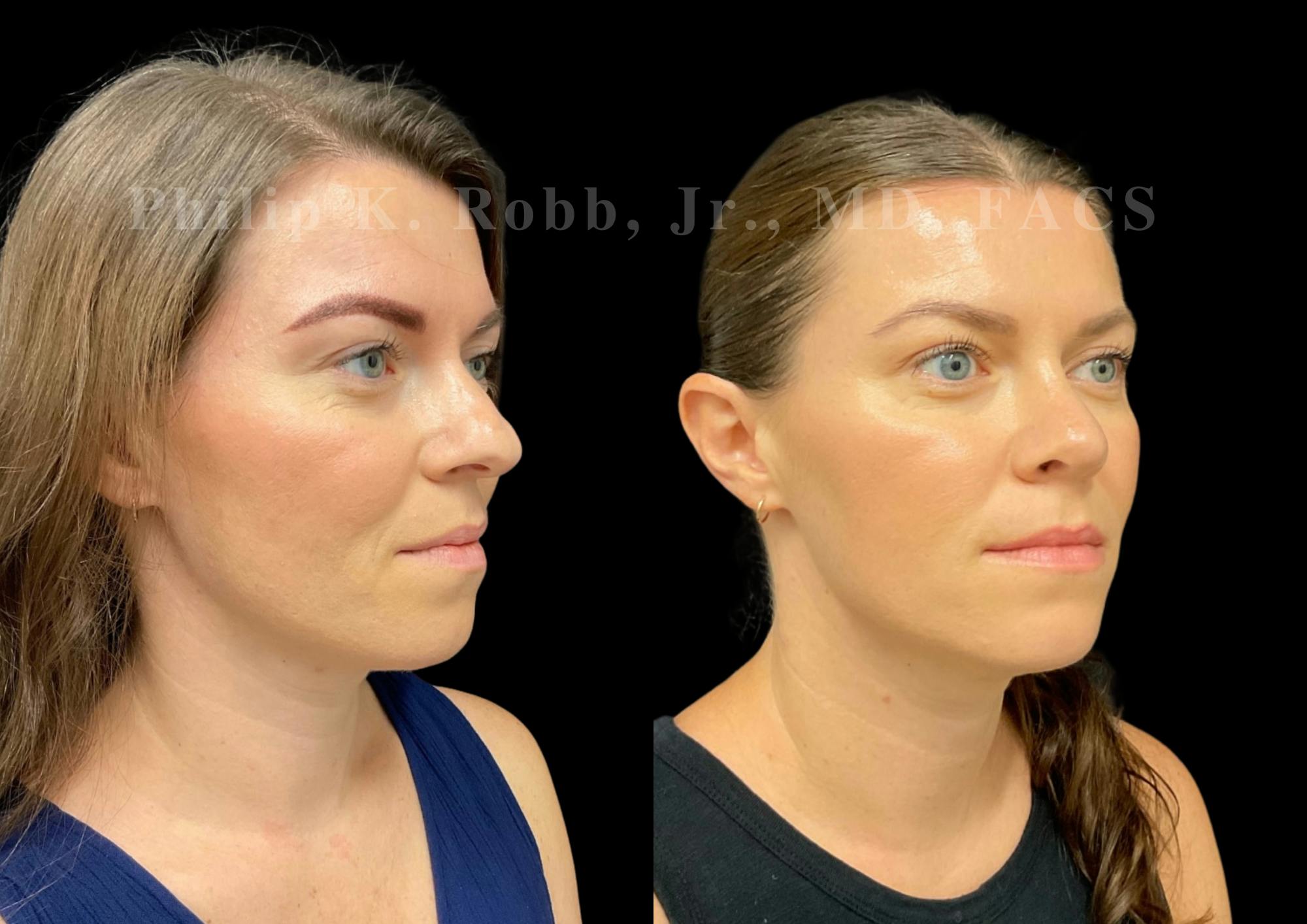 Ultrasonic Rhinoplasty Before & After Gallery - Patient 349449 - Image 2