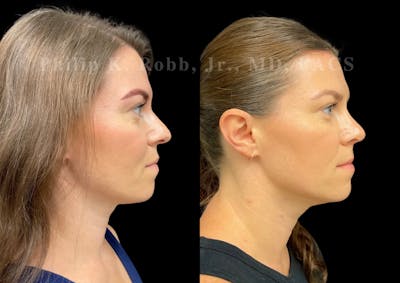 Ultrasonic Rhinoplasty Before & After Gallery - Patient 349449 - Image 1