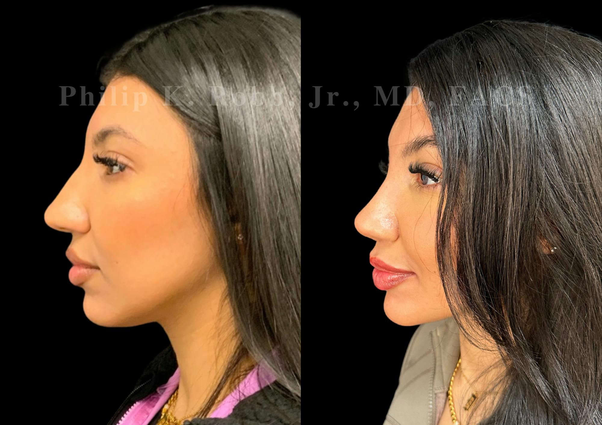 Ultrasonic Rhinoplasty Before & After Gallery - Patient 183026 - Image 5