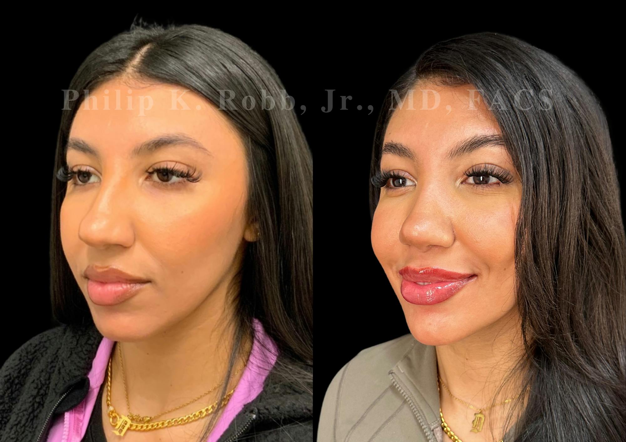 Ultrasonic Rhinoplasty Before & After Gallery - Patient 183026 - Image 4