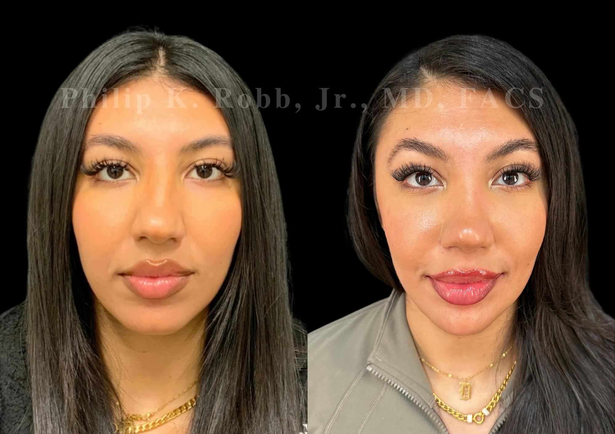 Ultrasonic Rhinoplasty Before & After Gallery - Patient 183026 - Image 3