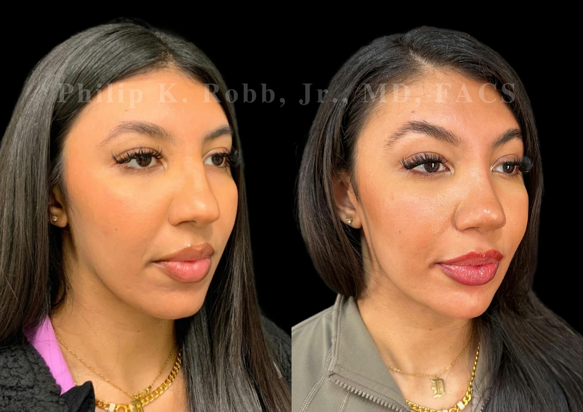Ultrasonic Rhinoplasty Before & After Gallery - Patient 183026 - Image 2
