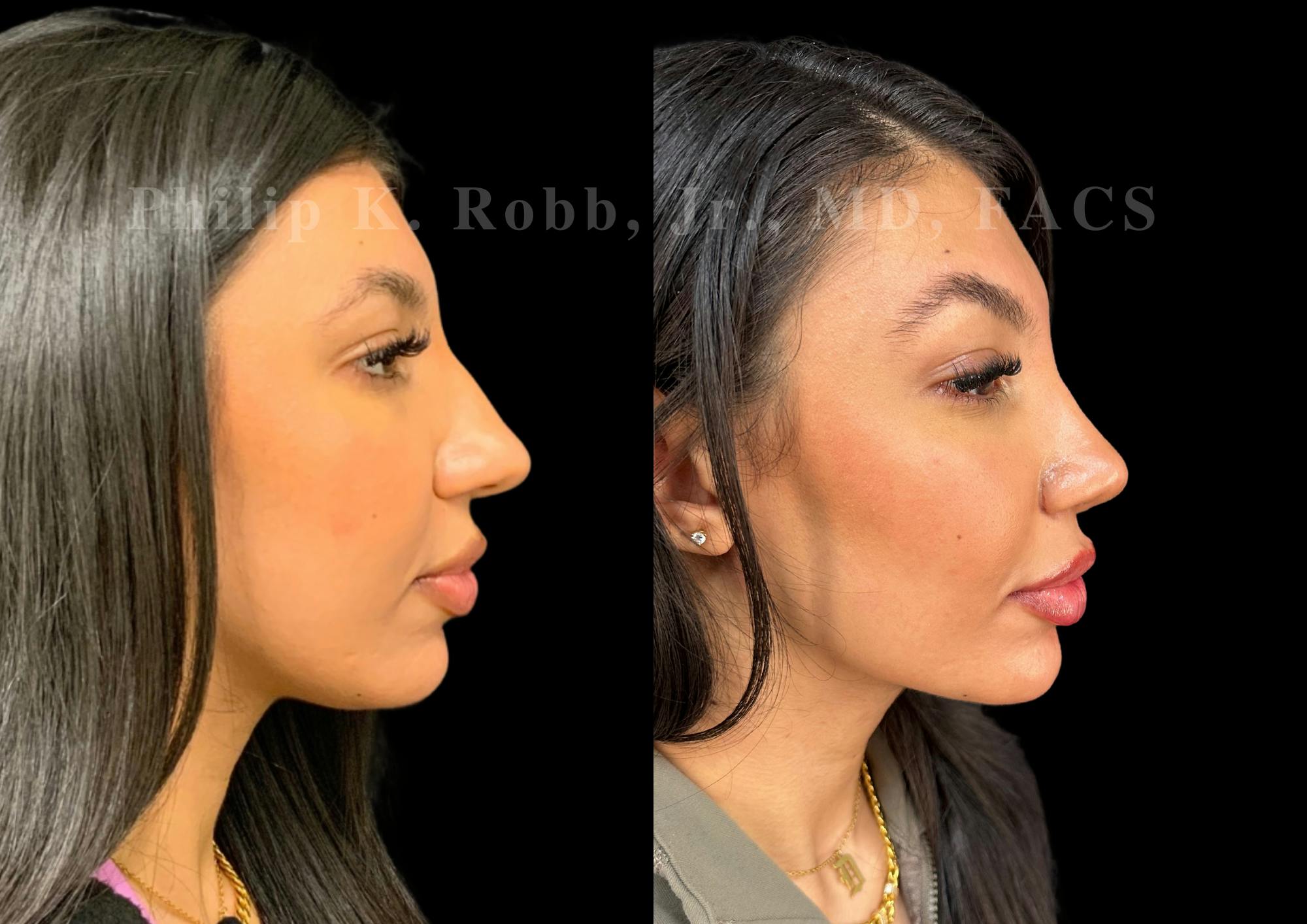 Ultrasonic Rhinoplasty Before & After Gallery - Patient 183026 - Image 1