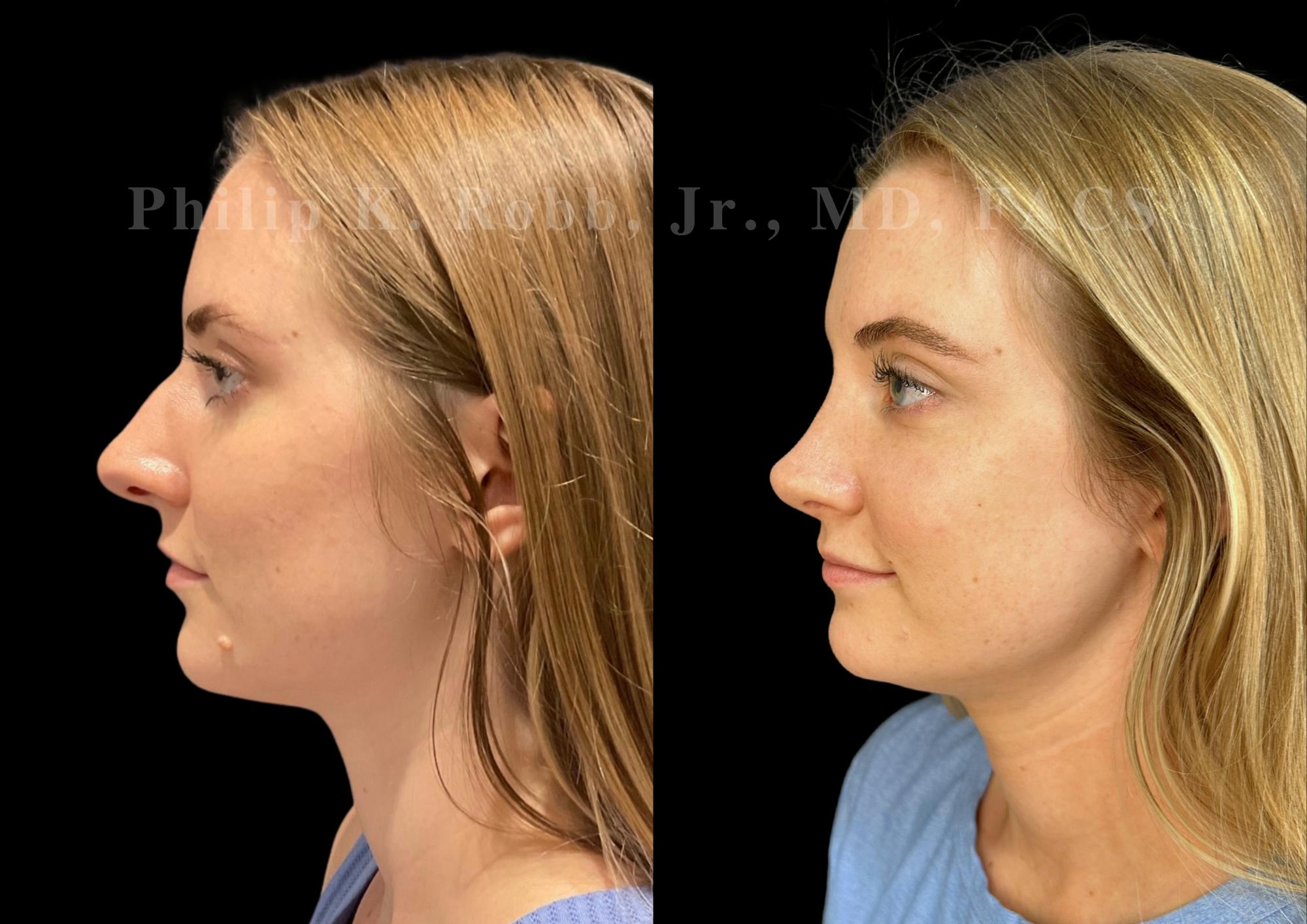 Ultrasonic Rhinoplasty Before & After Gallery - Patient 213407 - Image 5