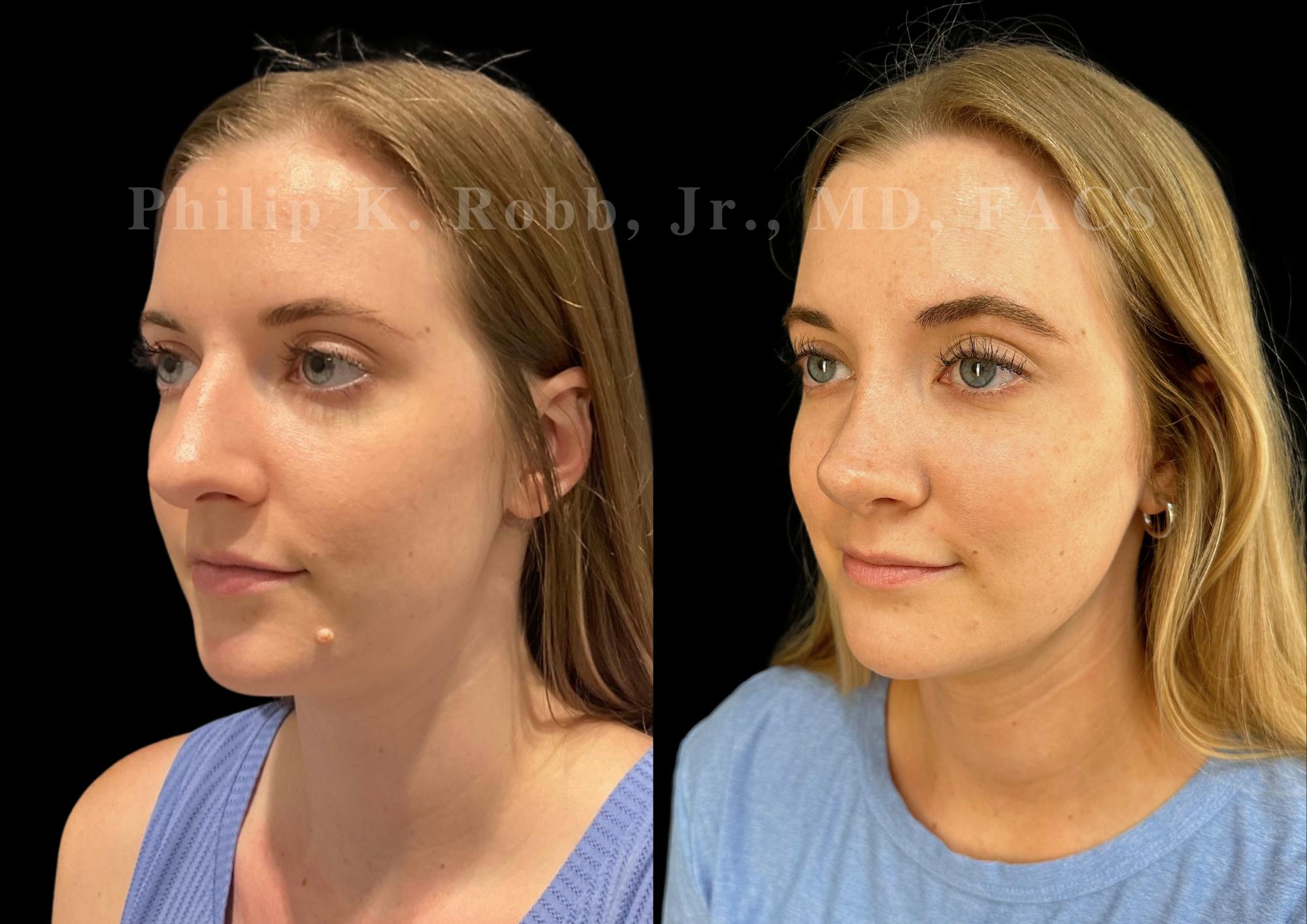 Ultrasonic Rhinoplasty Before & After Gallery - Patient 213407 - Image 4