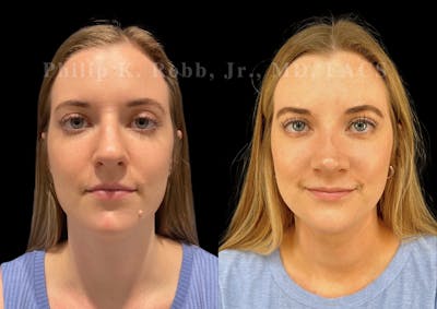 Mole Vaporization Before & After Gallery - Patient 558422 - Image 1