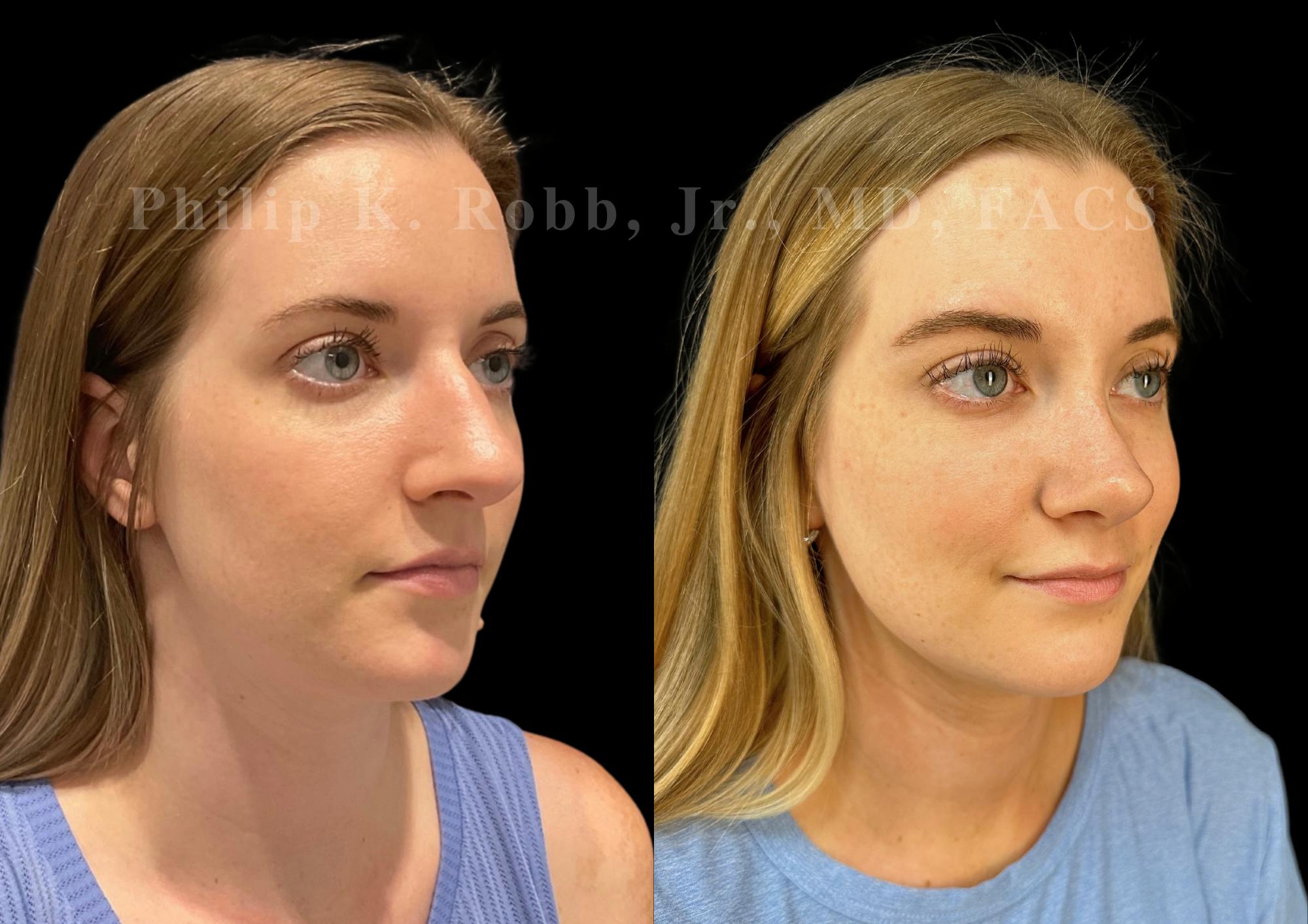 Ultrasonic Rhinoplasty Before & After Gallery - Patient 213407 - Image 2