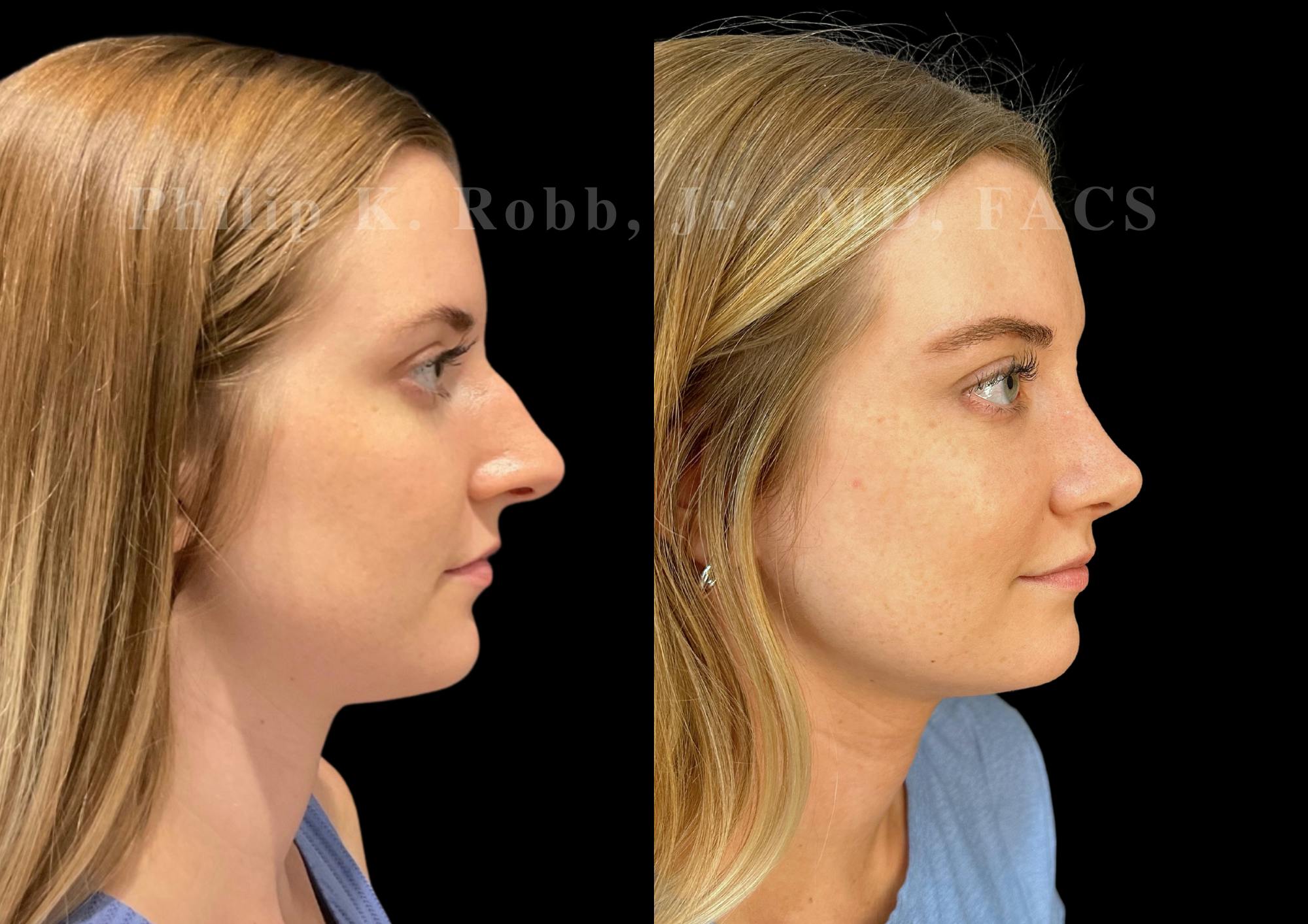 Ultrasonic Rhinoplasty Before & After Gallery - Patient 213407 - Image 1