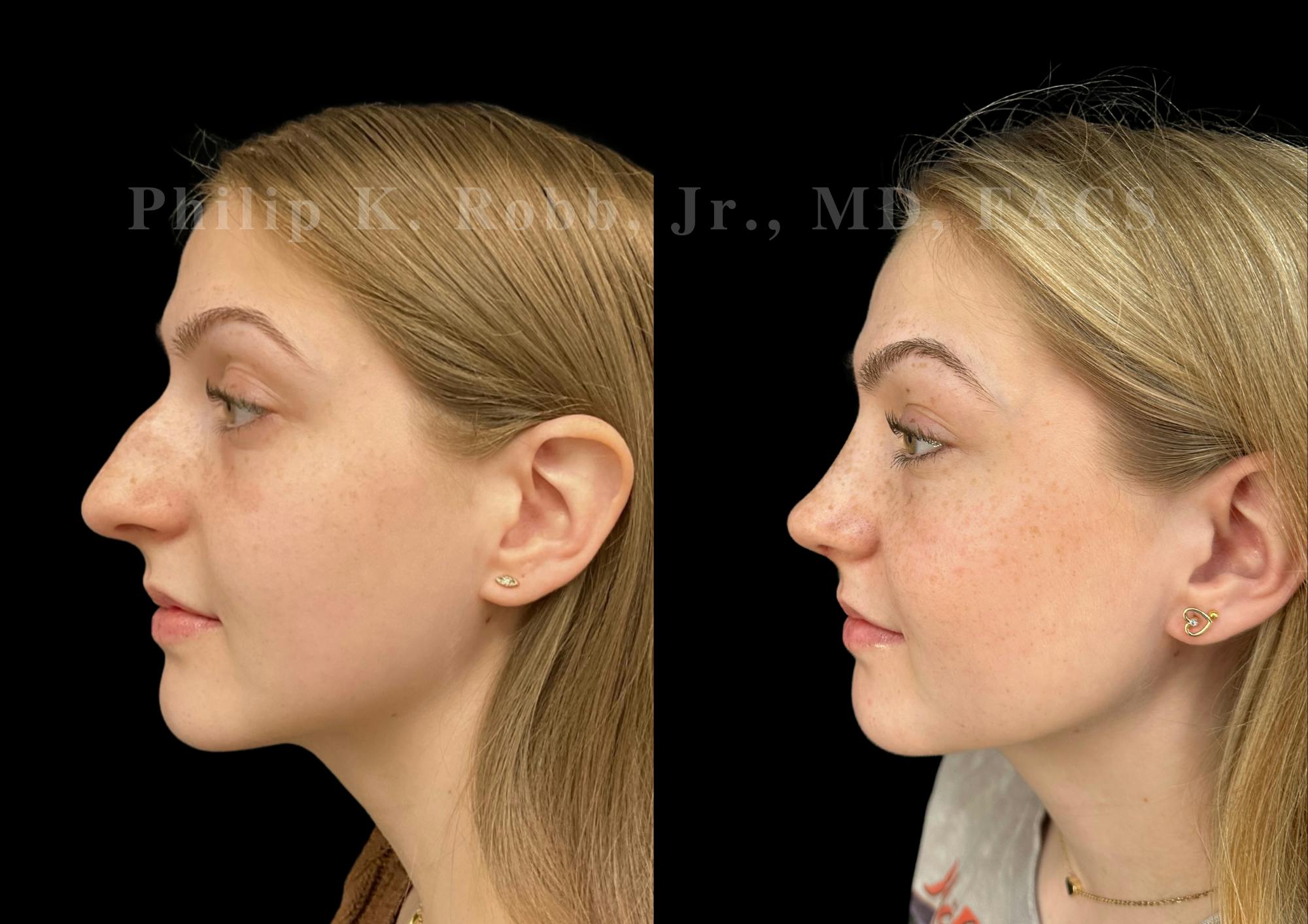 Ultrasonic Rhinoplasty Before & After Gallery - Patient 260976 - Image 5