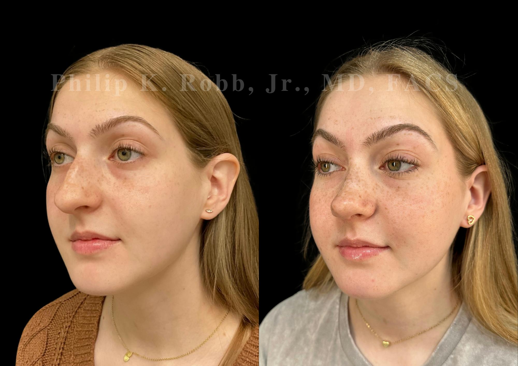 Ultrasonic Rhinoplasty Before & After Gallery - Patient 260976 - Image 4