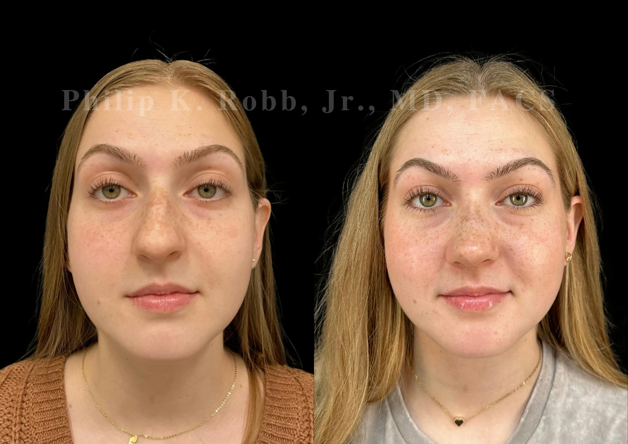 Ultrasonic Rhinoplasty Before & After Gallery - Patient 260976 - Image 3