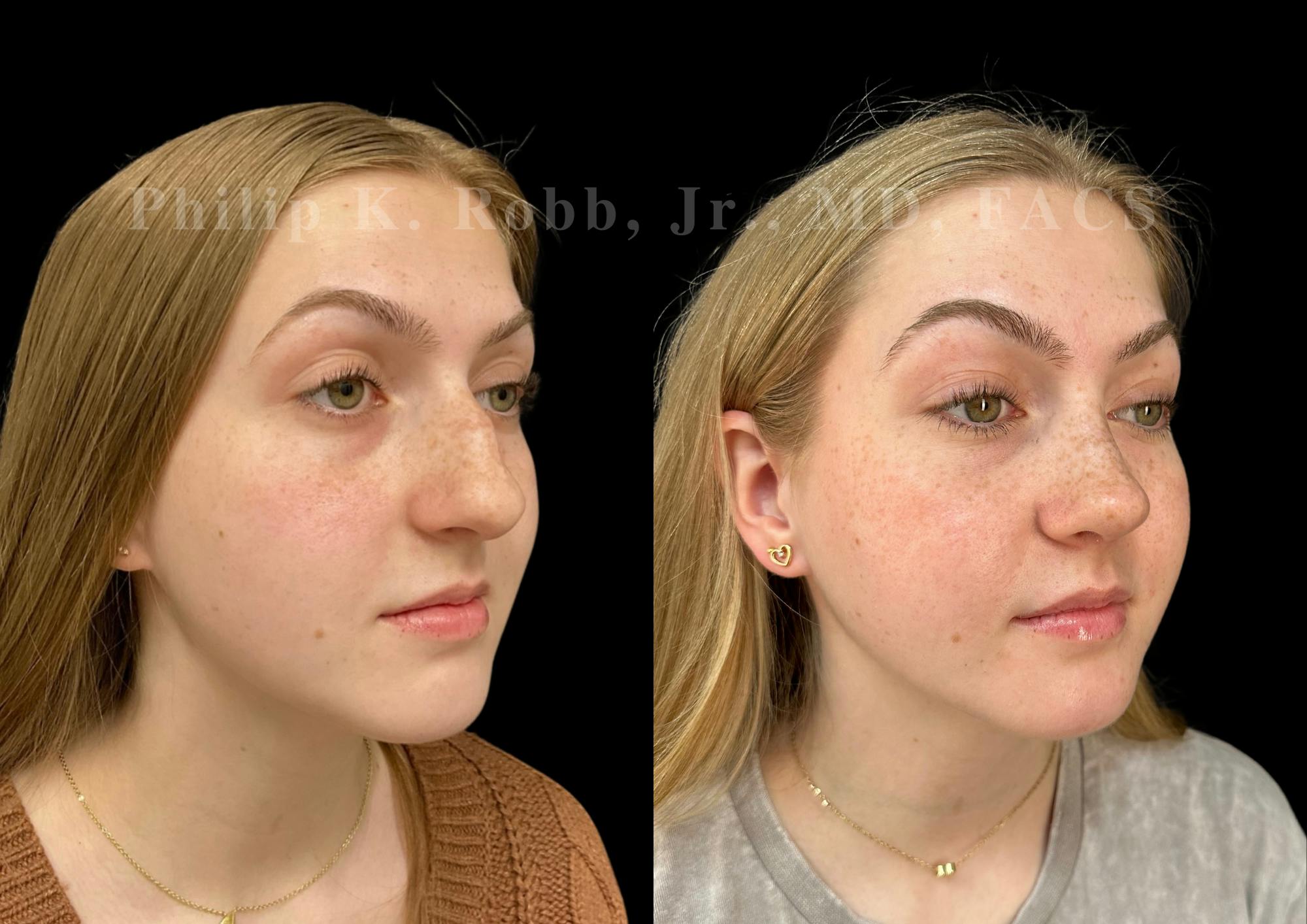 Ultrasonic Rhinoplasty Before & After Gallery - Patient 260976 - Image 2
