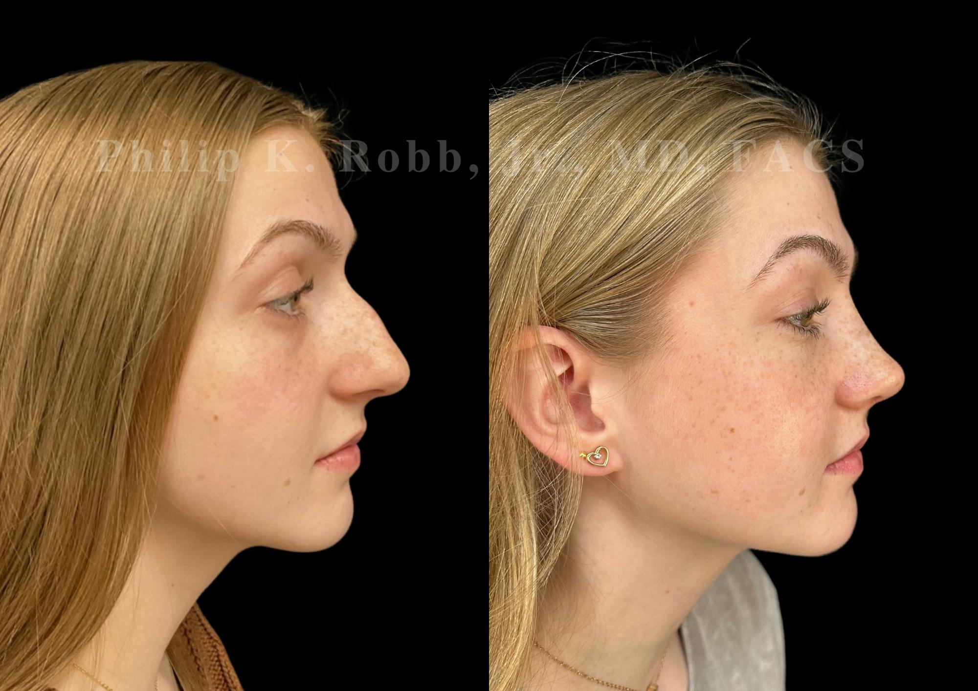 Ultrasonic Rhinoplasty Before & After Gallery - Patient 260976 - Image 1