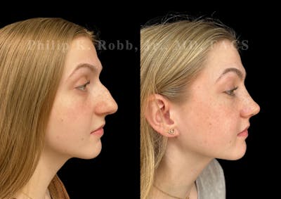 Ultrasonic Rhinoplasty Before & After Gallery - Patient 260976 - Image 1