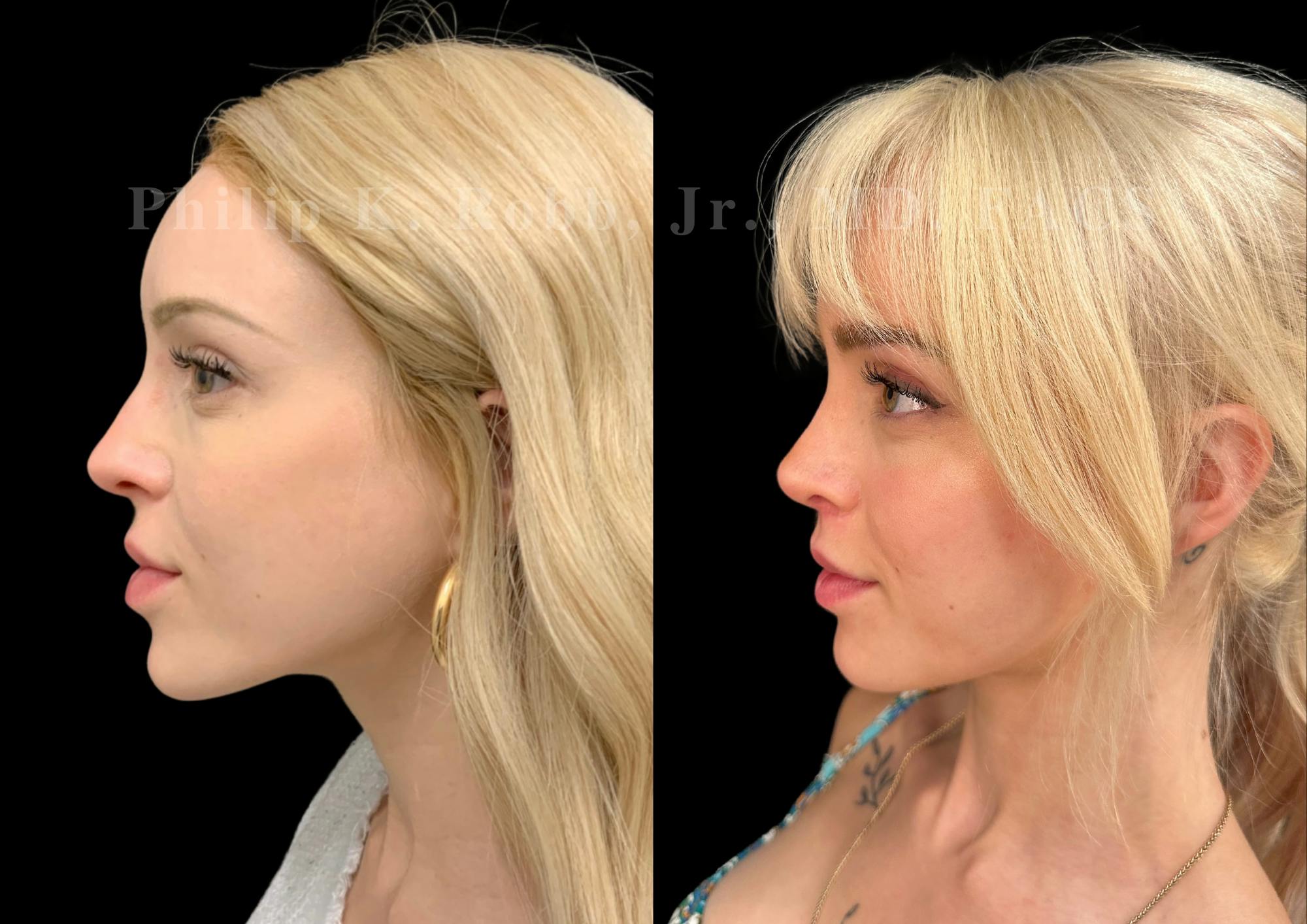 Ultrasonic Rhinoplasty Before & After Gallery - Patient 239973 - Image 5