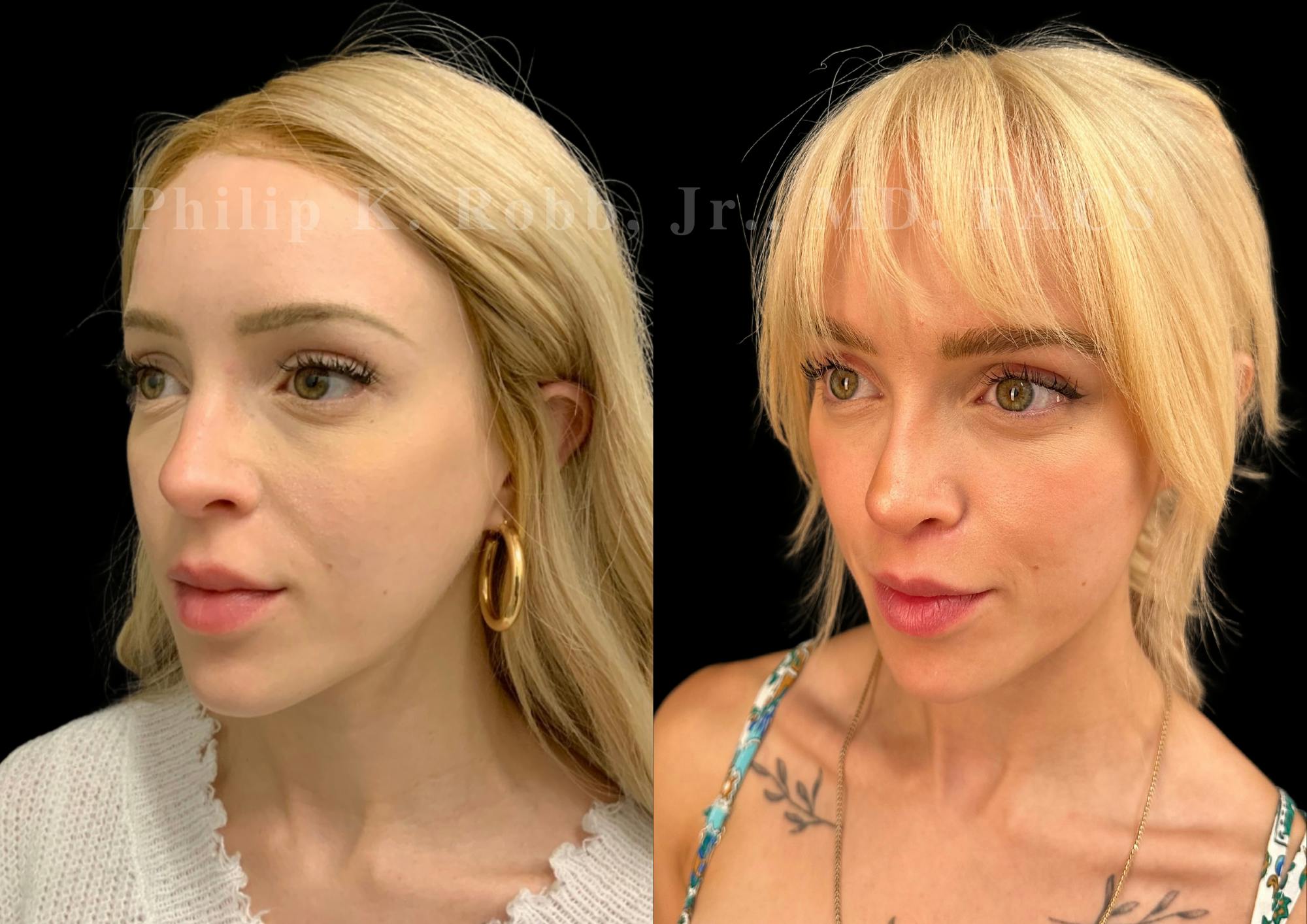 Ultrasonic Rhinoplasty Before & After Gallery - Patient 239973 - Image 4