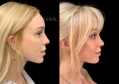 Ultrasonic Rhinoplasty Before & After Gallery - Patient 239973 - Image 1