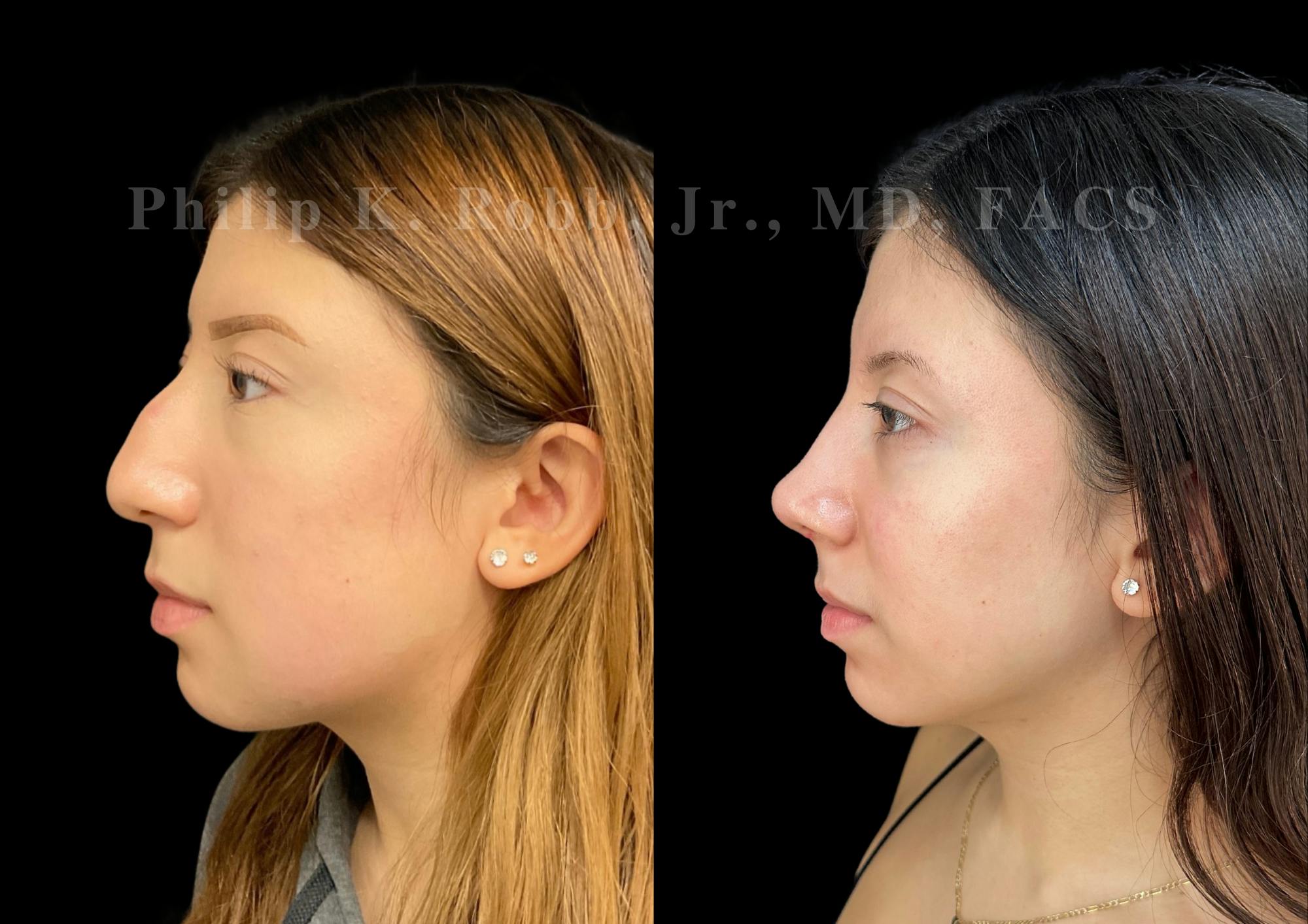 Ultrasonic Rhinoplasty Before & After Gallery - Patient 256465 - Image 5