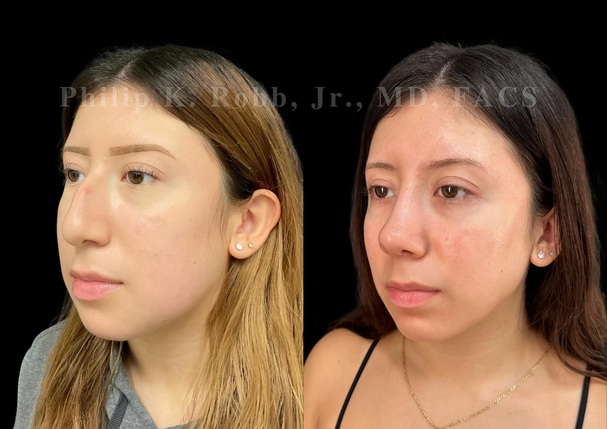 Ultrasonic Rhinoplasty Before & After Gallery - Patient 256465 - Image 4
