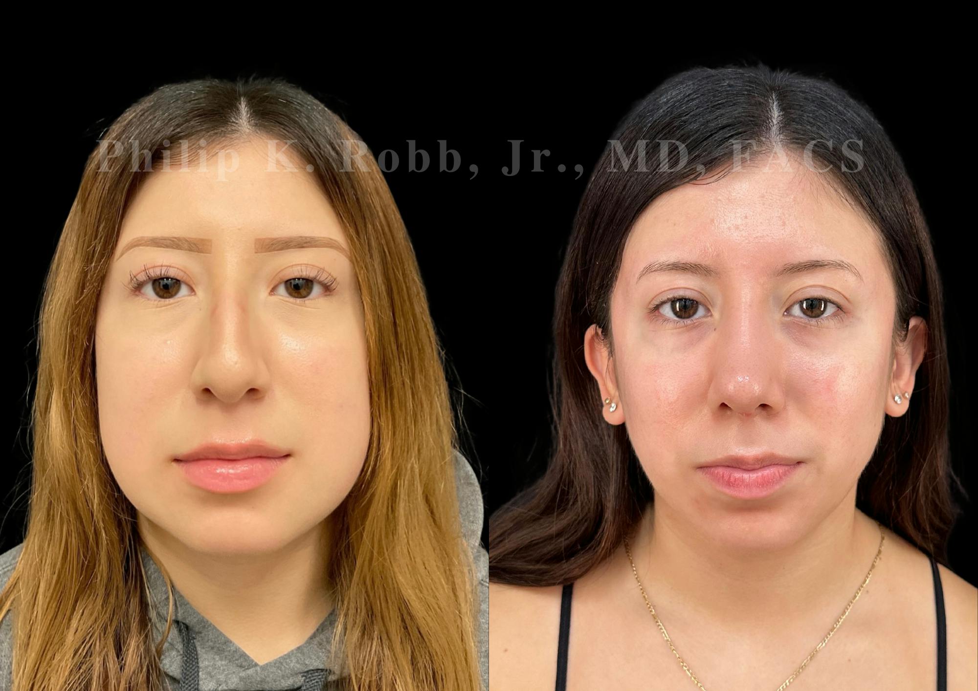 Ultrasonic Rhinoplasty Before & After Gallery - Patient 256465 - Image 3