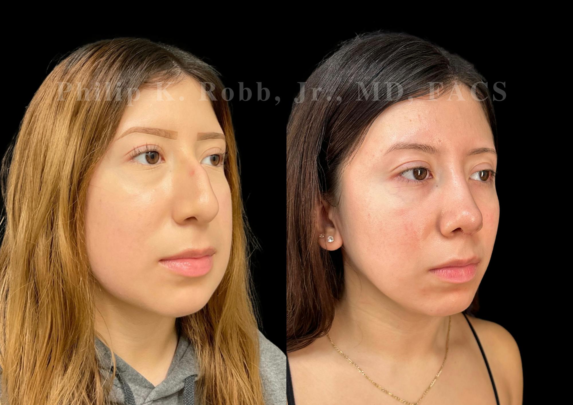 Ultrasonic Rhinoplasty Before & After Gallery - Patient 256465 - Image 2