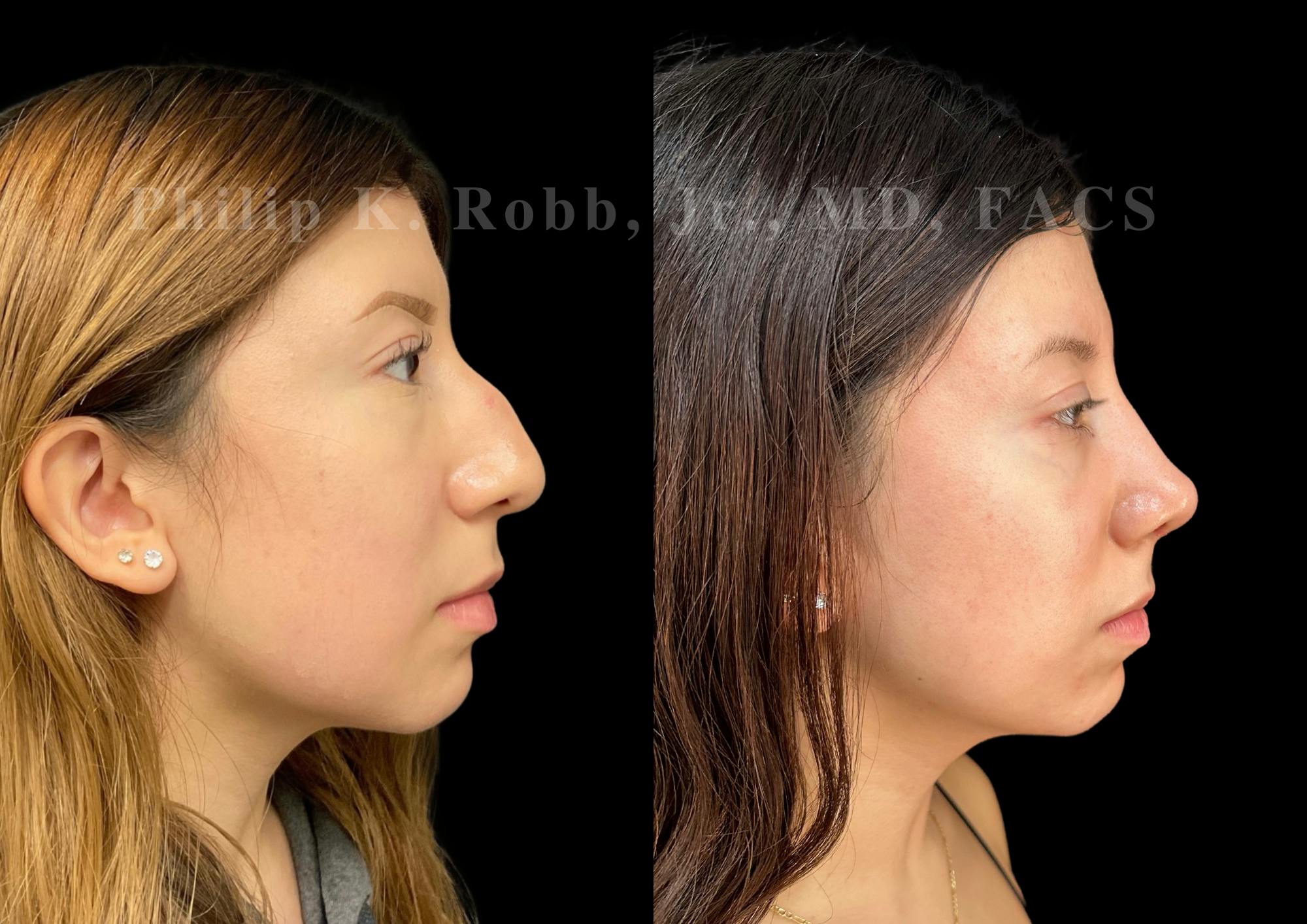 Ultrasonic Rhinoplasty Before & After Gallery - Patient 256465 - Image 1