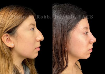 Ultrasonic Rhinoplasty Before & After Gallery - Patient 256465 - Image 1