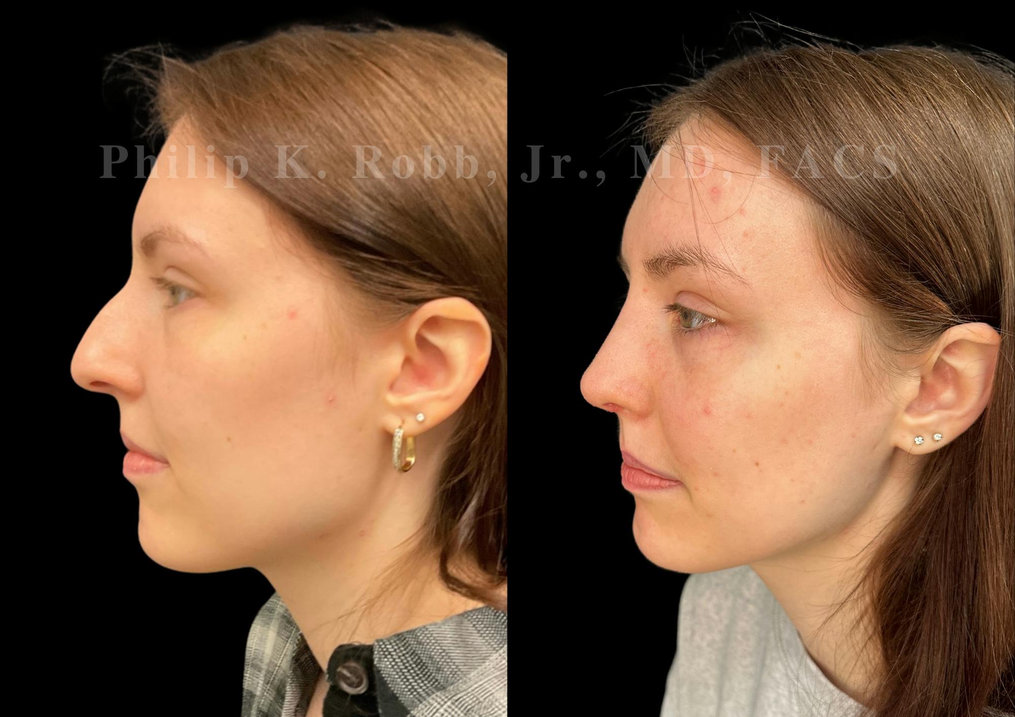 Ultrasonic Rhinoplasty Before & After Gallery - Patient 303760 - Image 5