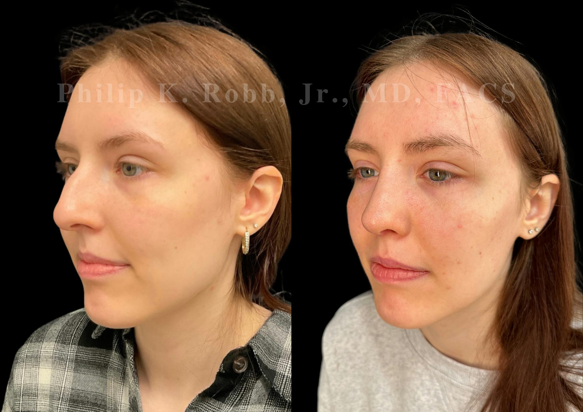 Ultrasonic Rhinoplasty Before & After Gallery - Patient 303760 - Image 4