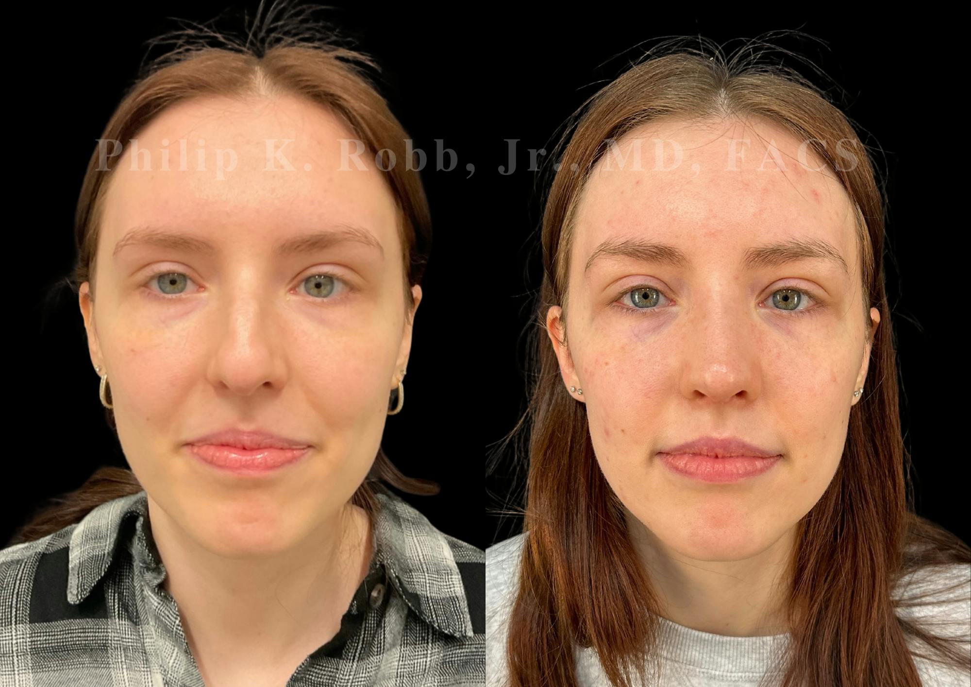 Ultrasonic Rhinoplasty Before & After Gallery - Patient 303760 - Image 3